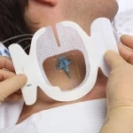 Повязка Tegaderm Тегадерм CHG 1657R для фиксации катетеров с хлоргексидина глюконатом, 8,5x11,5 см, 1 шт